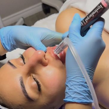 Is Acne Laser Treatment Beneficial For Teenagers – TrendSassy Laser & MedSpa